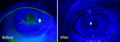 Eye surgeon in Nottingham. Ocular Surface Disease Treatments.