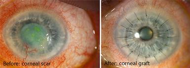 Eye surgeon in Nottingham. Corneal graft surgery treatment.