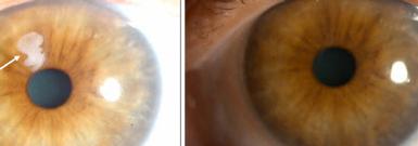 Eye surgeon in Nottingham. Refractive Laser Surgery Treatment.